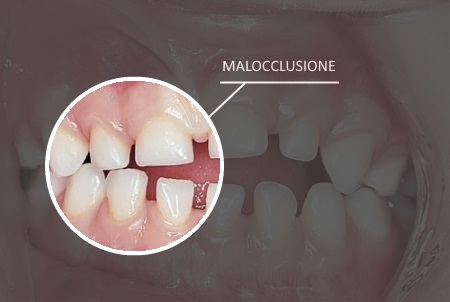 Malocclusione Ortodonzia problemi di masticazione sviluppo dei denti Genova Studio dentistico dentista genova centro