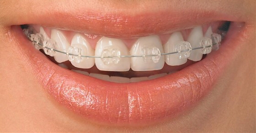 Studio dentistico dentista genova centro urgenza dentistica implantologia Ortodonzia brackets in composito o ceramica policristallina trasparente