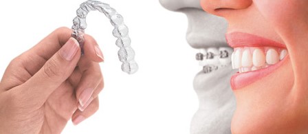 Studio dentistico dentista genova centro urgenza dentistica implantologia Ortodonzia brackets totalmente invisibili da esterno