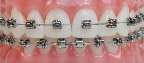 Studio dentistico dentista genova centro urgenza dentistica implantologia Ortodonzia mascherine trasparenti rimovibili Invisalign
